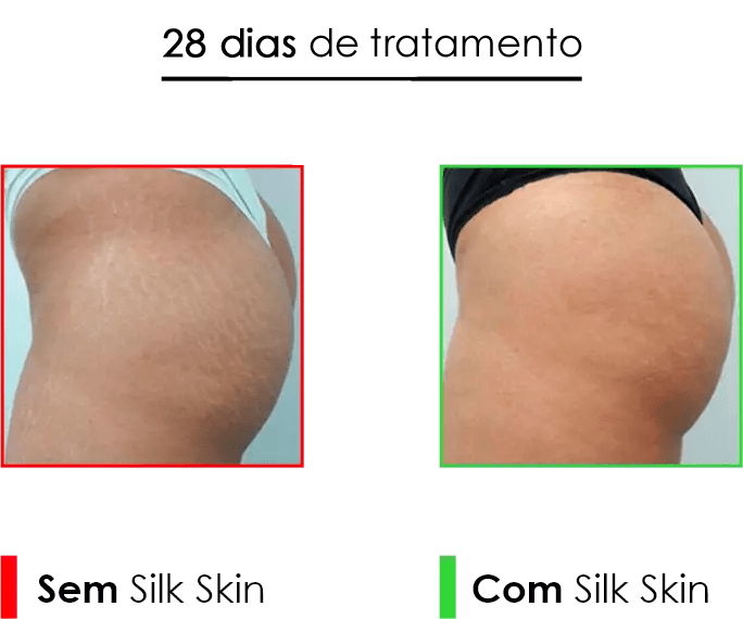 Skin Creme: 28 dias de Tratamento para Estrias