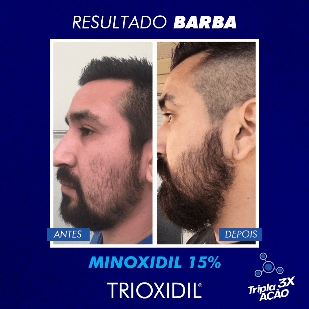 crescer cabelo e barba 