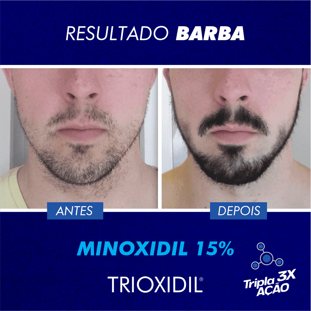 TRIOXIDIL EU BARBUDO