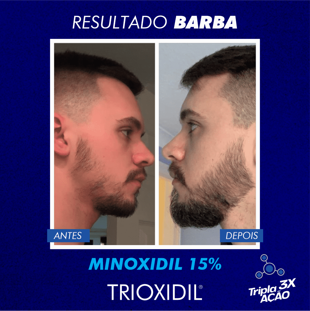 remédio para crescer cabelo e barba 