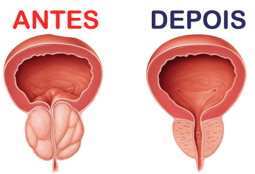 PowerProst Caps Forma Natural de Tratar a Próstata e Controle Urinário