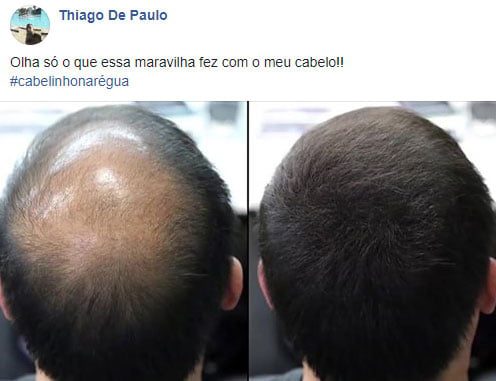 KORUVITAL fim da queda de cabelo