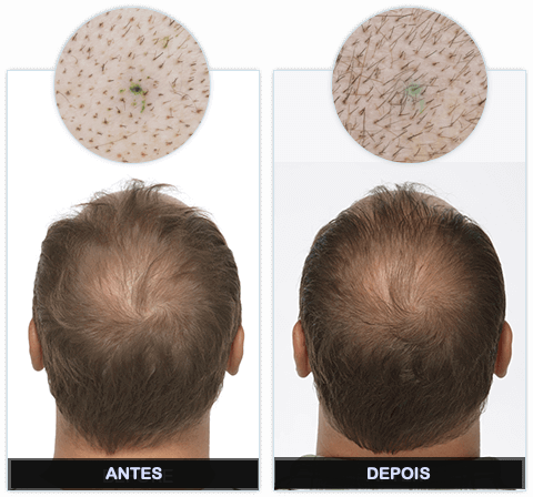 KORUVITAL resultado antes e depois