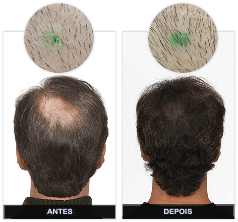 KORUVITAL funciona antes e depois