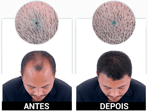 KORUVITAL é bom antes e depois