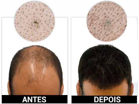 KORUVITAL vale a pena antes e depois