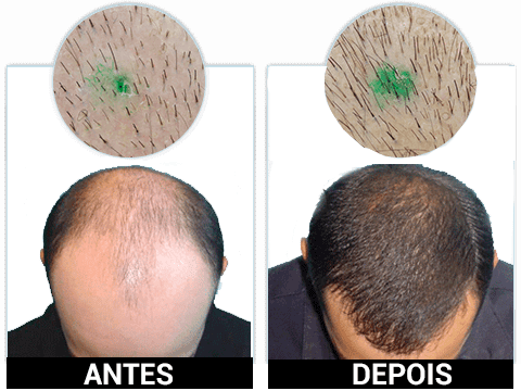 KORUVITAL é seguro antes e depois