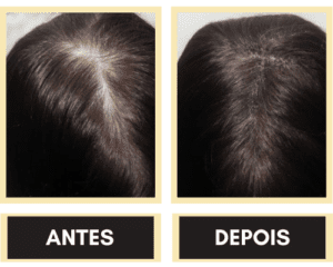 Trioxidil Spartan Funciona O Que É Bula Antes e Depois Preço